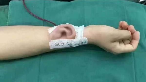 手臂上的耳朵　陸醫生妙手自體造耳