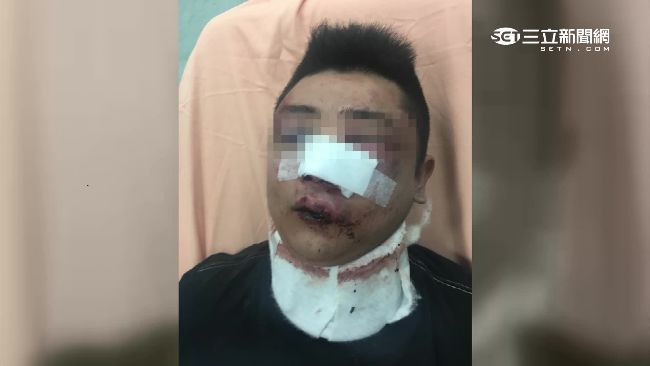 詐騙慣犯遭3男圍毆　鼻裂牙斷變豬頭