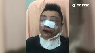 詐騙慣犯遭3男圍毆　鼻裂牙斷變豬頭