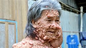 全身長滿腫瘤的60歲男子希蒂（圖／翻攝自每日郵報）