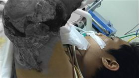 高雄市立小港醫院副院長傅尹志繼創下全球首例鱷魚嘴
下斷肢接合成功紀錄，又為遭火車斷臂命懸一線的顏姓
青少年接回斷臂（圖），喜獲重生。他形容這次手術是
浴血奮戰。
（小港醫院提供）
中央社記者程啟峰高雄傳真  105年11月27日