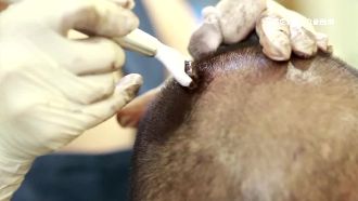 治禿髮新招用刺的！針扎顏料增髮量感