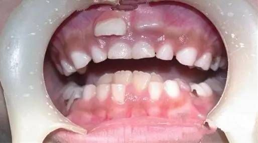 家長沒注意！8歲男童長出「雙排牙」