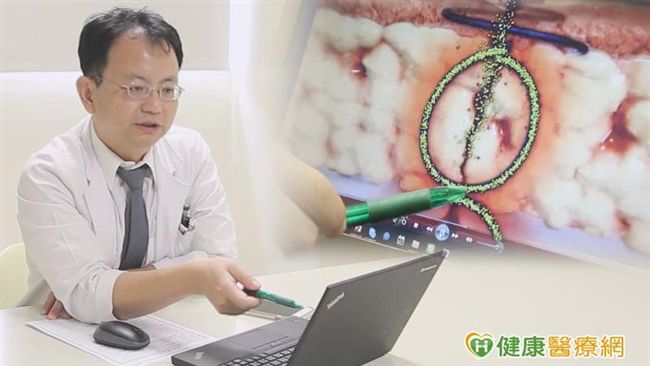 WHO：這種縫線　可降低感染風險