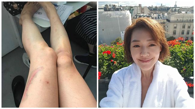 小S曬大腿傷照　網友虧：是不是家暴