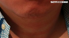 一位50歲男性臉經常紅紅的，常被誤以為是喝酒引起，經健檢發現竟是罹患「真性紅血球增生症」。（圖／書田診所提供）