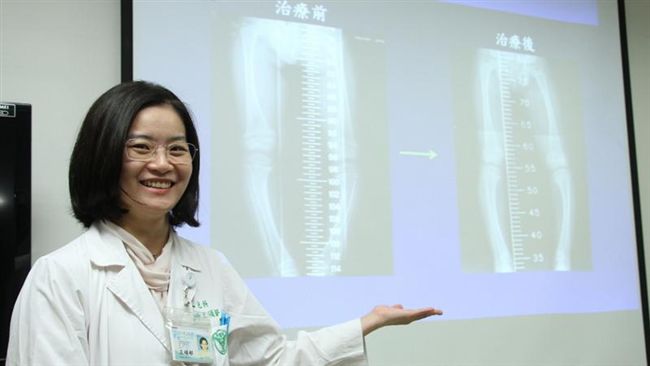 孩童O型腿　醫師警告：恐是佝僂症