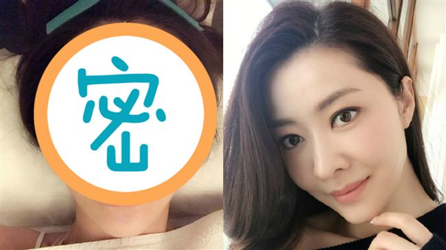 愛美不擇手段！熊黛林素顏「扎滿針」