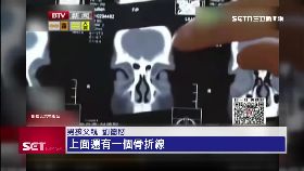 F拋童摔骨折1200