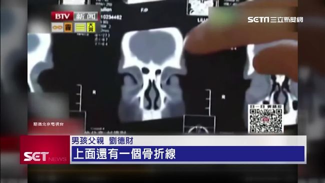 「飛高高」出意外！　4歲童頭骨摔裂