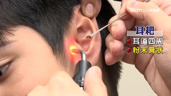 耳垢乾溼=有無狐臭？日研究：98%