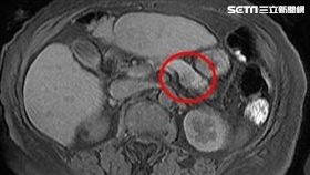 胰島素瘤90%以上是良性瘤，當然也有惡性變化的可能，主要症狀是會產生低血糖。（圖／台北慈濟醫院提供）