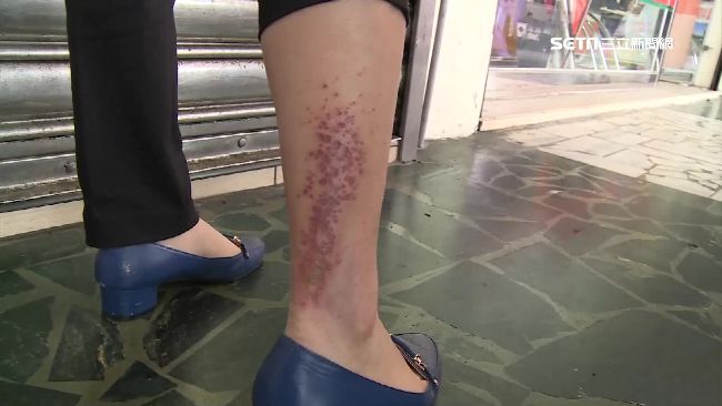 泡湯腿如腐蝕　業者冷回應：妳的問題