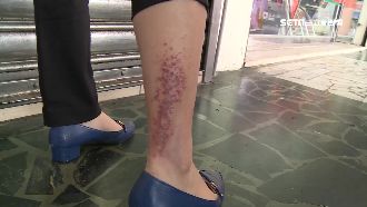 泡湯腿如腐蝕　業者冷回應：妳的問題