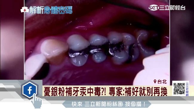 憂銀粉補牙汞中毒？專家：補好就別換
