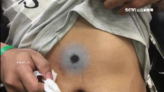 隨機鎮暴彈槍擊　男腹部現硬幣大傷口