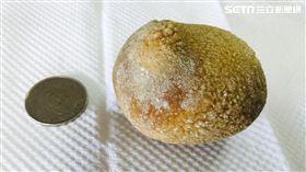 陳男罹患膀胱結石，結石竟有6公分，大如奇異果般。（圖／童綜合醫院提供）