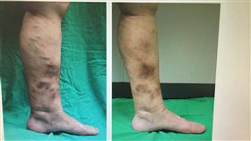 靜脈曲張,健康,傷口,復原,中山醫學大學
圖／中央社