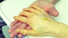 美國，夫妻，肥大細胞活躍症（圖／翻攝自BBC）