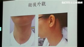 台大切頭頸部腫瘤，術後不留痕技術為全球首創。（圖／楊晴雯攝）