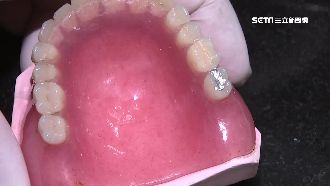 銀粉還是樹脂？醫師揭密補牙哪一種好