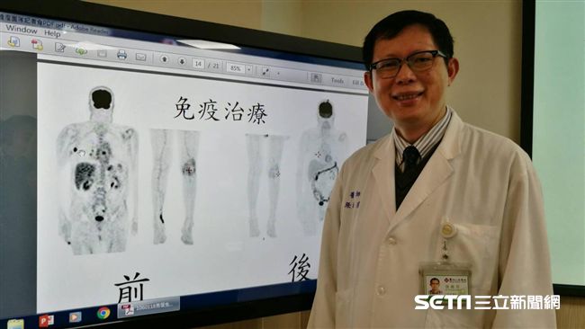 嚇！手指頭有小黑點　竟是癌症找上門