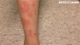 乾癬，許寶寶。（圖／大林慈濟醫院提供）