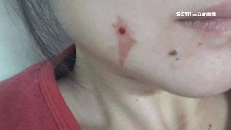 補牙補到毀容　女控診所「傷後不理」