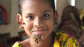 樹人症,夏哈那,罕見,疾病,孟加拉,每日郵報,Shahana Khatun,英國,樹皮 圖／每日郵報　https://goo.gl/o9LMQy