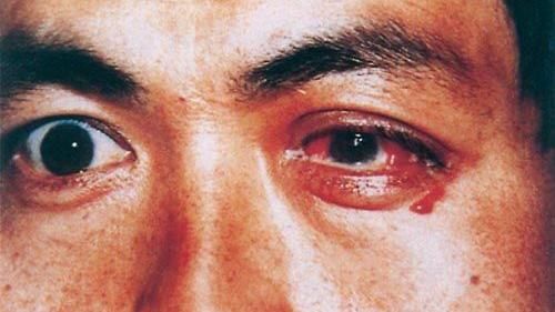 愛愛完沒洗手　三男眼睛接連染淋病