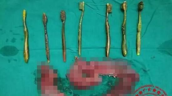 女子腹痛急送醫　醫生取出7支牙刷