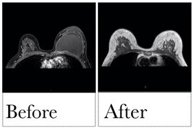 一名中國大陸女子隆胸後竟胸部兩邊極不對稱，察覺有異來台尋求診治。（圖／北投健康管理醫院提供）