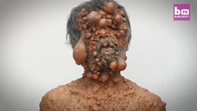 罕病男全身長滿腫瘤　就連兒子也懼怕