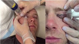 每日郵報,刺青,清除,眼皮,醉後大丈夫,酒醉,喝酒　圖／翻攝自每日郵報