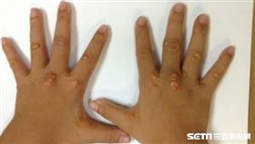 醫師常敏之表示，家族性高膽固醇血症患者的臨床症狀，常在手肘、膝蓋關節與腳跟出現黃色的脂肪瘤。（圖／醫師常敏之提供）