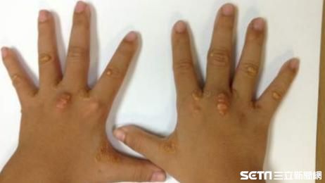膽固醇爆表！5歲童關節冒黃脂肪瘤