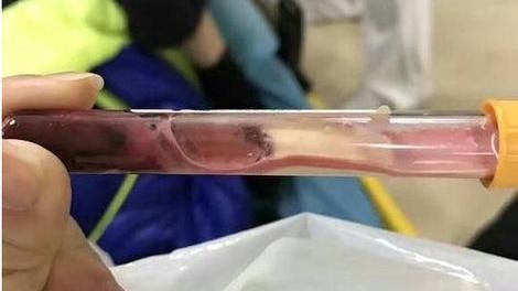 父母太溺愛孩子　他血液抽出馬上凝固