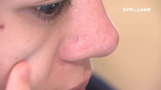 小蘇打能除粉刺？醫：洗馬桶的來洗臉