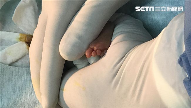 心導管術救478克的她　成醫破紀錄