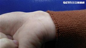 27歲的陳女因天天使用電腦長達10小時，右手腕明顯凸起一顆瘤狀物，就醫檢查是罹患腱鞘囊腫。（圖／童綜合醫院提供）