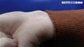 27歲的陳女因天天使用電腦長達10小時，右手腕明顯凸起一顆瘤狀物，就醫檢查是罹患腱鞘囊腫。（圖／童綜合醫院提供）