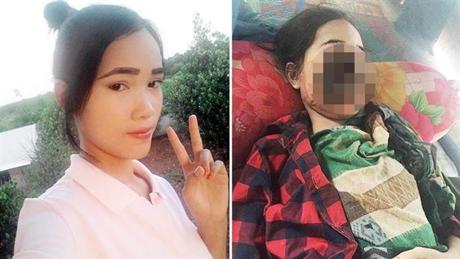 少女拔牙感染食肉菌　臉被吃掉一大半