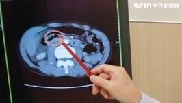 酒駕男車禍無外傷，十二指腸破裂差點喪命。