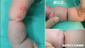 醫師蘇宇平表示，小凱出生時整個右小腿如蓮藕般被掐成兩段，皺褶以下的肢體因循環不良而腫脹。（圖／台北榮總提供）