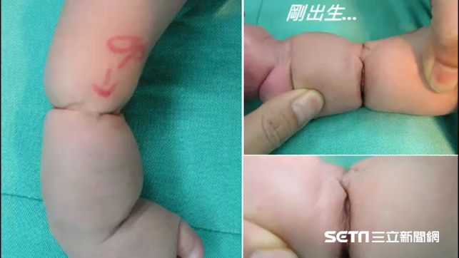 出生小腿如蓮藕　全因這病作怪...