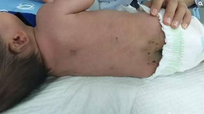 聽信偏方放血　男嬰被扎30多針命危
