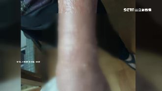 只是塗酸痛藥膏　婦人雙手紅腫起水泡