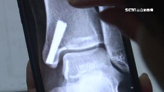 少女骨折當擦傷？母批醫院「太草率」