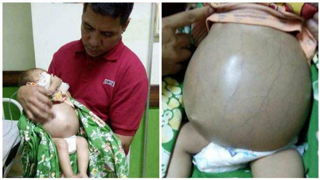 驚！男嬰肚子離奇脹大　竟是因為…