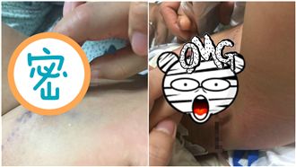 一歲童餵馬遭咬傷　右手指節難接回